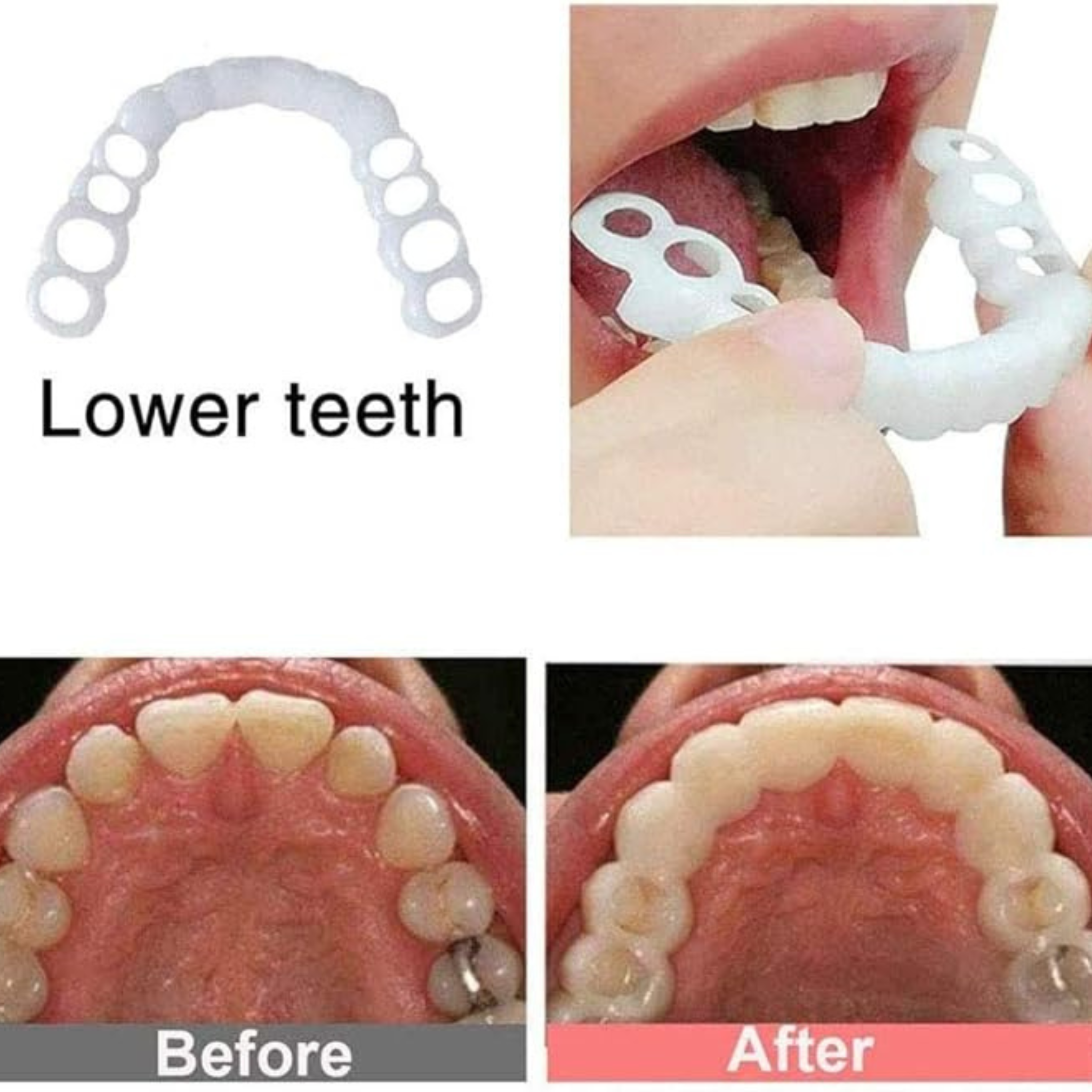 SnapOn Smile Dental Veneers – قشرة ابتسامة سناب أون